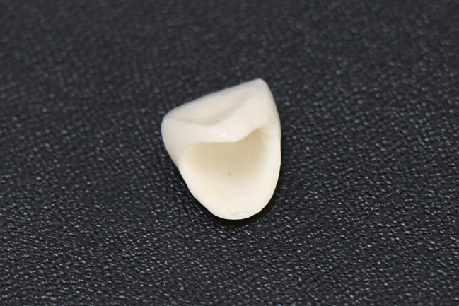 詰め物・かぶせ物 オールセラミックスクラウン