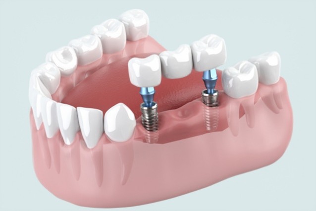 インプラント 人工歯根