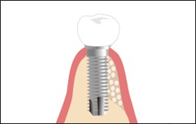 骨造成術 インプラント