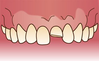 歯の脱臼 外傷