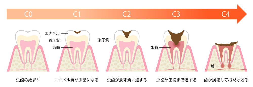 虫歯の進行段階