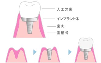治療　インプラント　人工の歯
