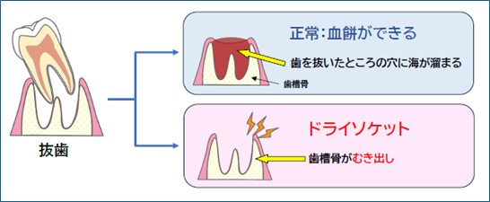 抜歯　血餅　ドライソケット
