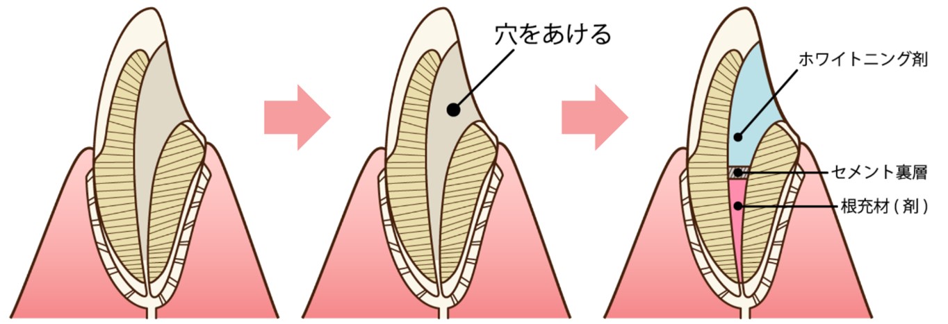 ウォーキングブリーチ