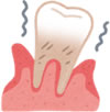 歯周組織への障害