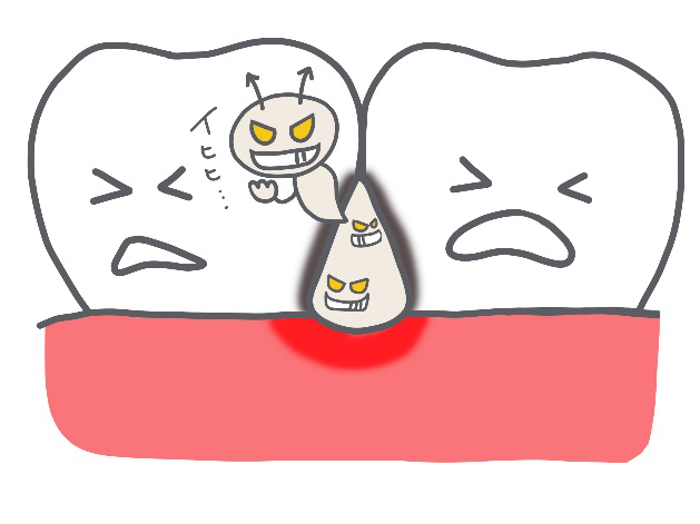 歯 隙間 むし歯