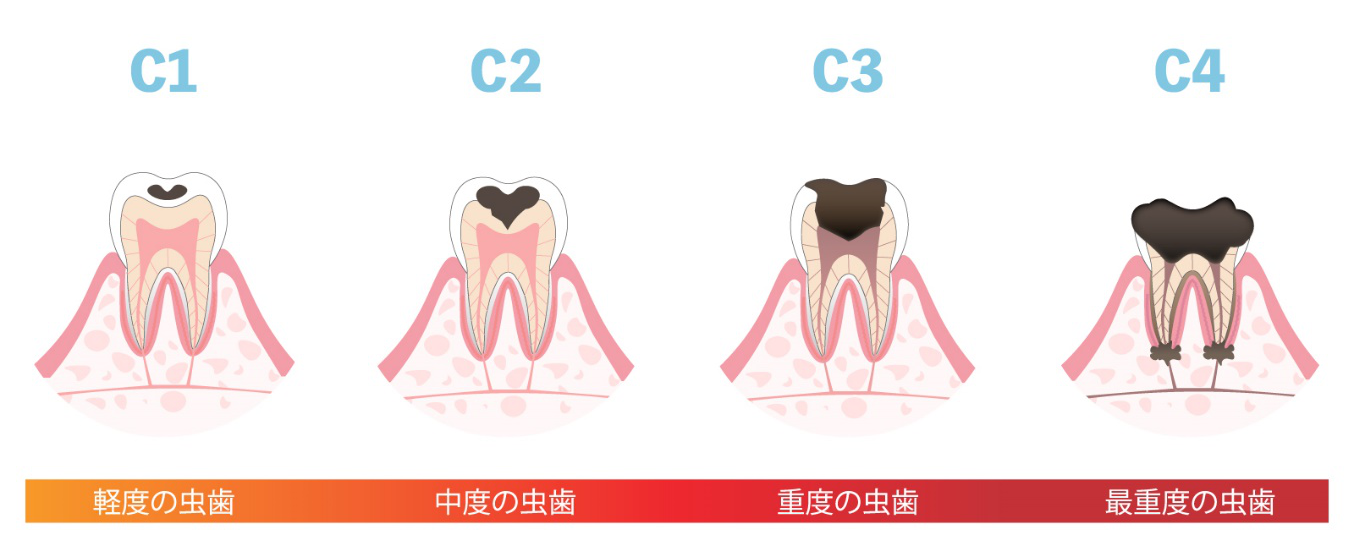 虫歯の段階