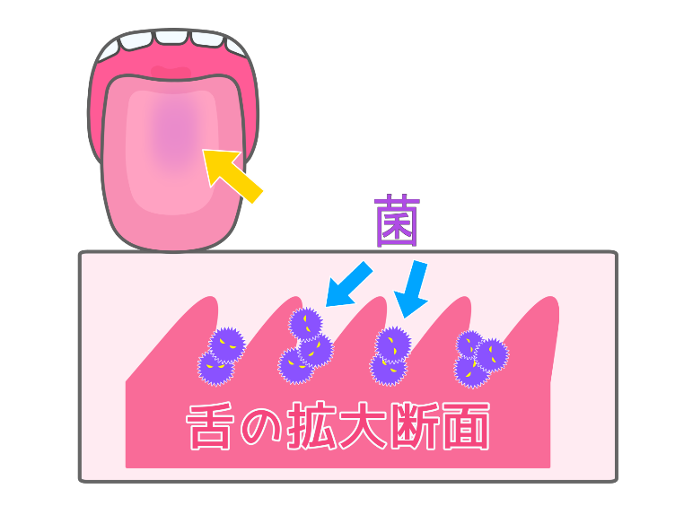 口臭　舌　断面