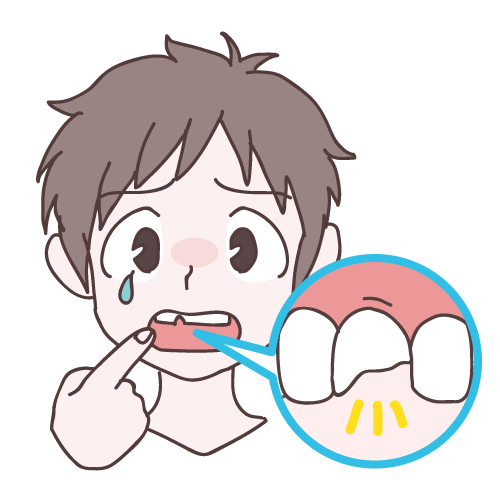 前歯 欠けた 転倒