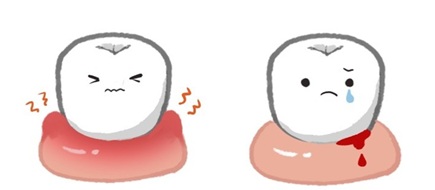 歯周病 歯ぐき 炎症
