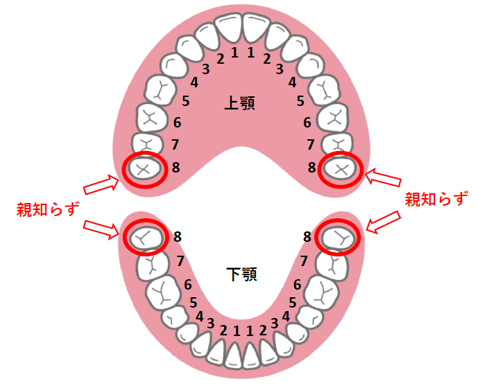親知らず　まっすぐ生えない　抜歯