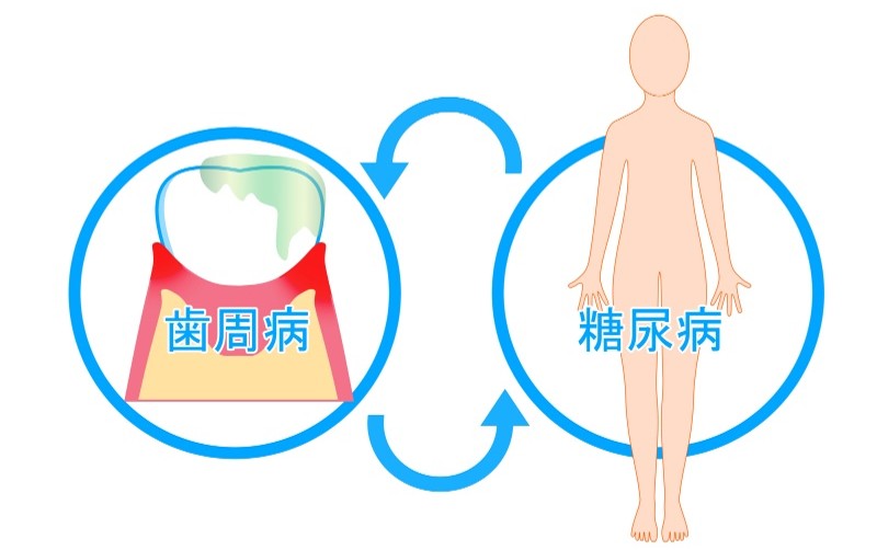 糖尿病と歯周病