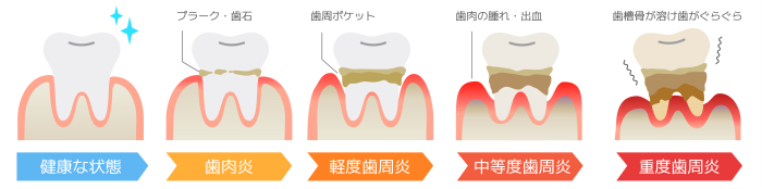 歯の汚れ　歯周病　プラーク