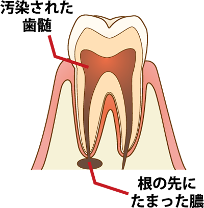 歯の内部