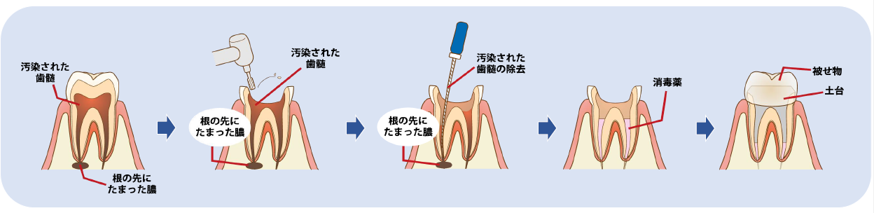 根管治療の流れ　歯　断面