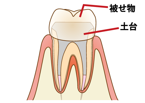 神経処置後　土台　被せ物