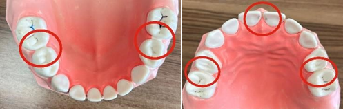 乳歯の虫歯ができやすい部位