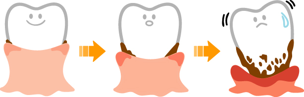 歯　歯周炎　小児歯科