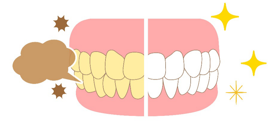ホワイトニング　前歯　前後