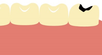 虫歯や歯周病の原因になる