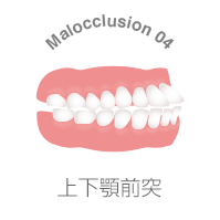 上下顎前突とは