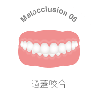 過蓋咬合とは