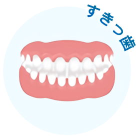 歯と歯の隙間が目立つ