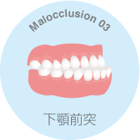 下顎前突とは