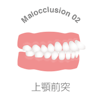 上顎前突とは
