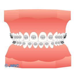 マルチブラケット矯正