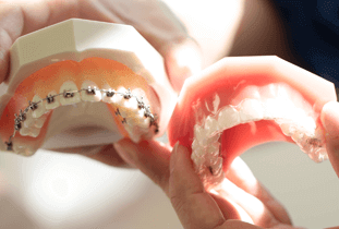 マウスピース矯正装置をつけた歯の模型