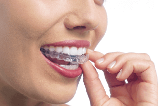 マウスピースを装着する口元