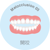 開咬とは