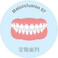空隙歯列とは