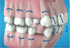 歯の移動方法