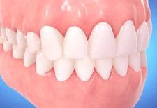 治療後の歯並び予測